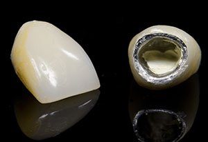 couronne ceramo métallique